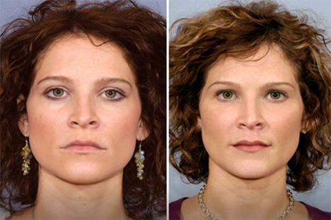 Dermal Fillers before after