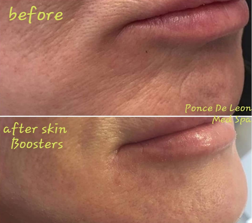 skin booster before after