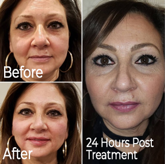 Woman with Platelet-Rich Fibrin Facelift Treatment Before and After