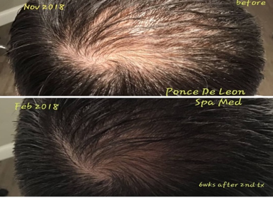 PRF Hair loss treatment PlateletRich Fibrin LondonHarleystreet