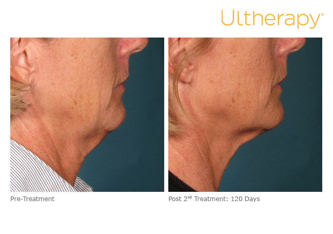 Ultherapy Side Neck Before and After