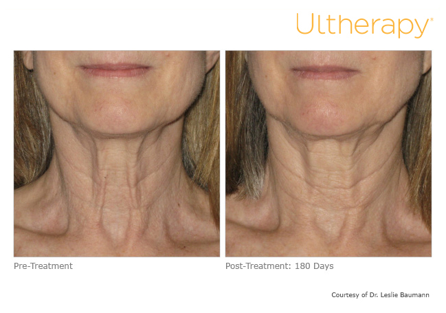 Ultherapy Front Neck Before and After