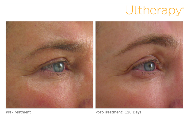 Ultherapy Eyebrow Before and After